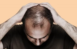 Baldness Problem