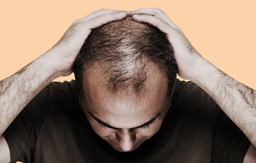 Baldness Problem