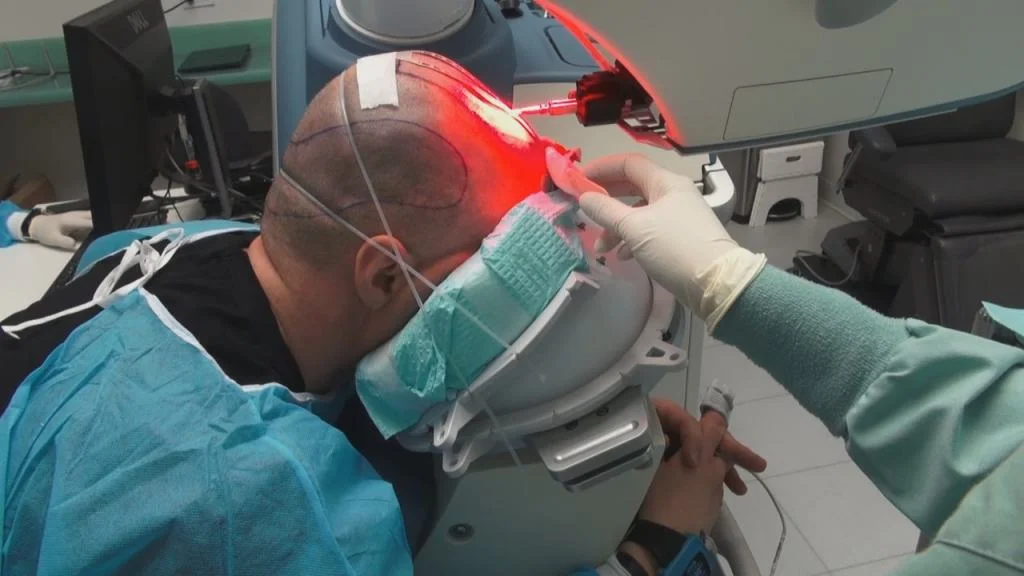 FUE-Haartransplantation