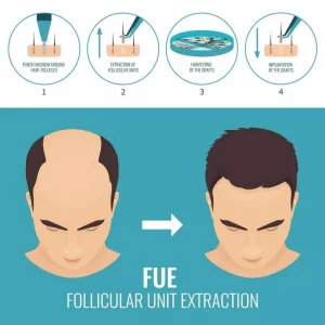 FUE Technique