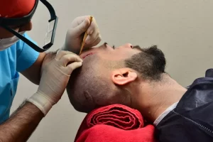 FUE Technique