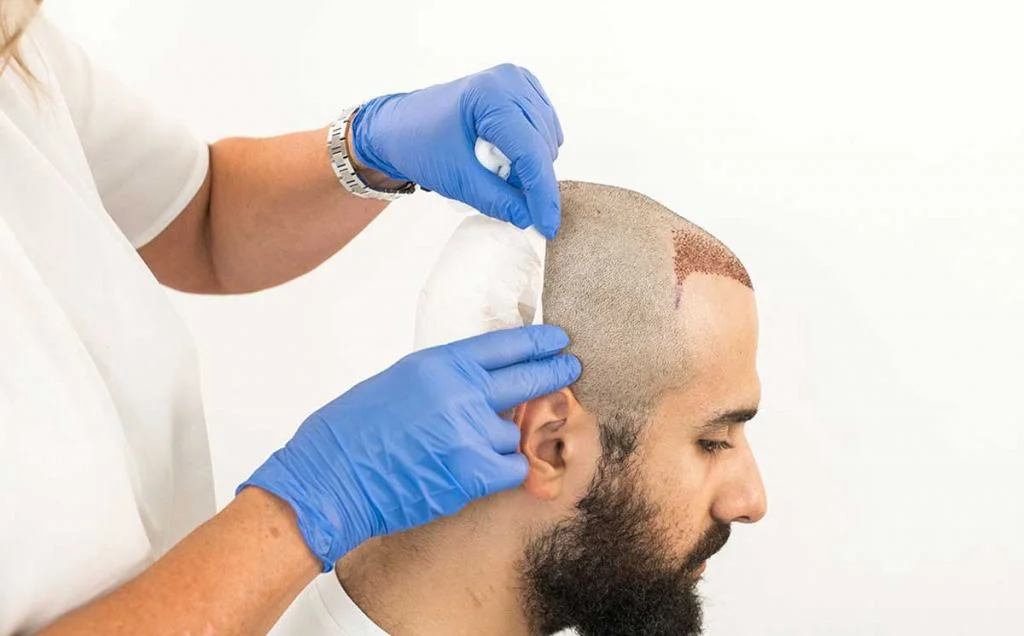 Fue-Haartransplantation