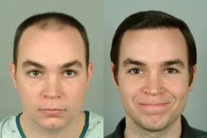 Hair Transplant