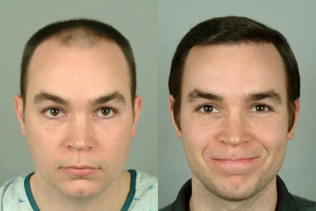 Hair Transplant