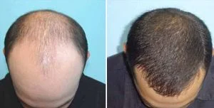 Hair Transplant