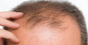 Hair Transplant