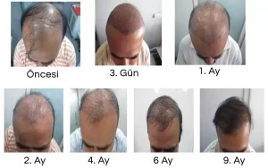 Hair Transplant Time