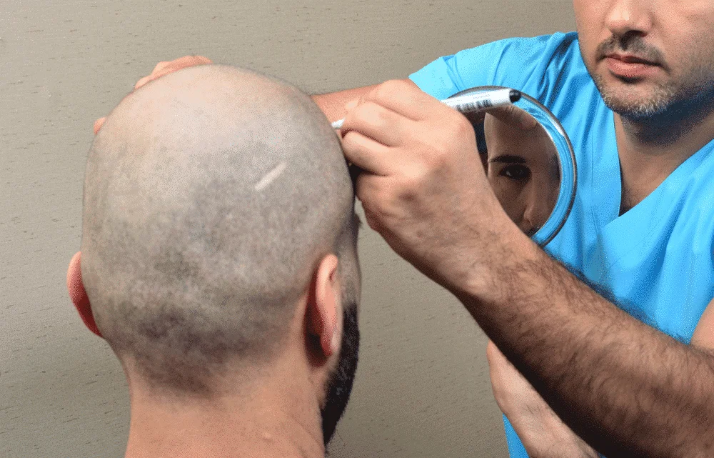 Hair Transplant Time