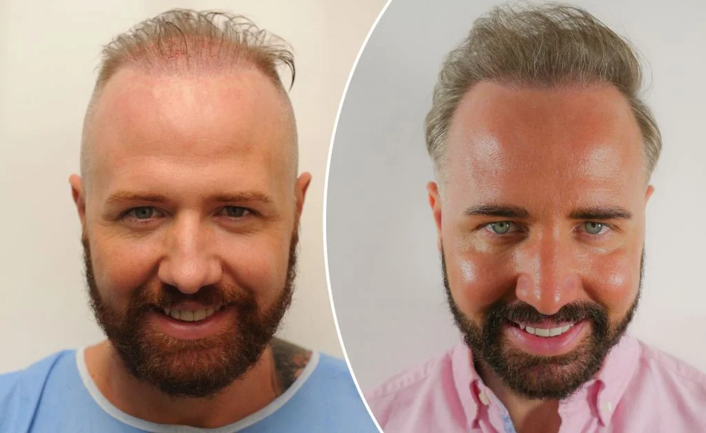 Hair Transplant