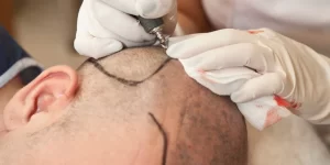 Plastik Cerrah ile FUE Saç Ekimi