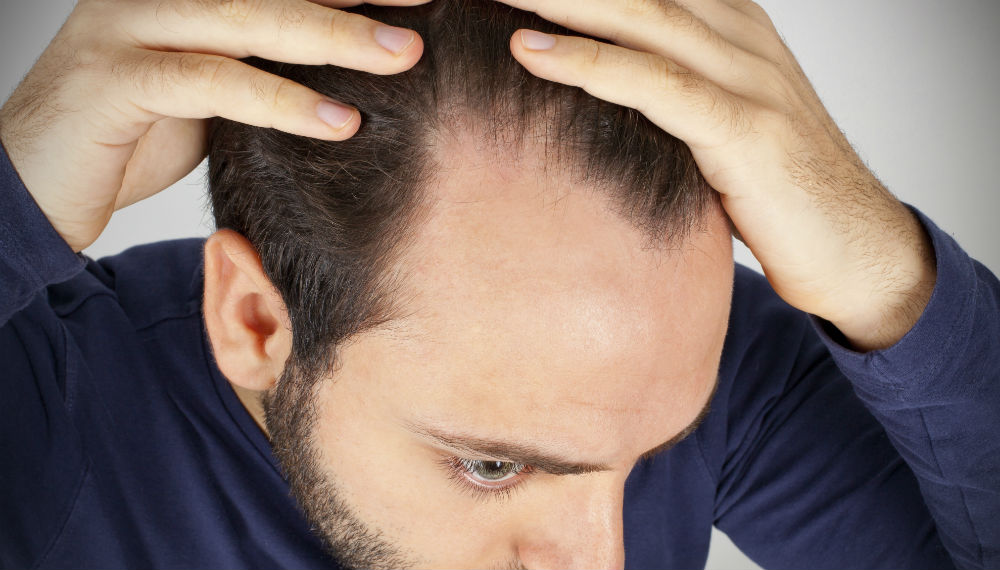 Saç Dökülmesi Tipleri