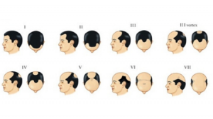 saç dökülmesi tipleri