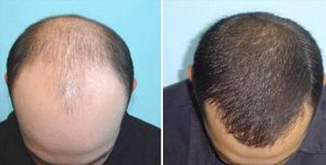 saç ekimi öncesi ve sonrası